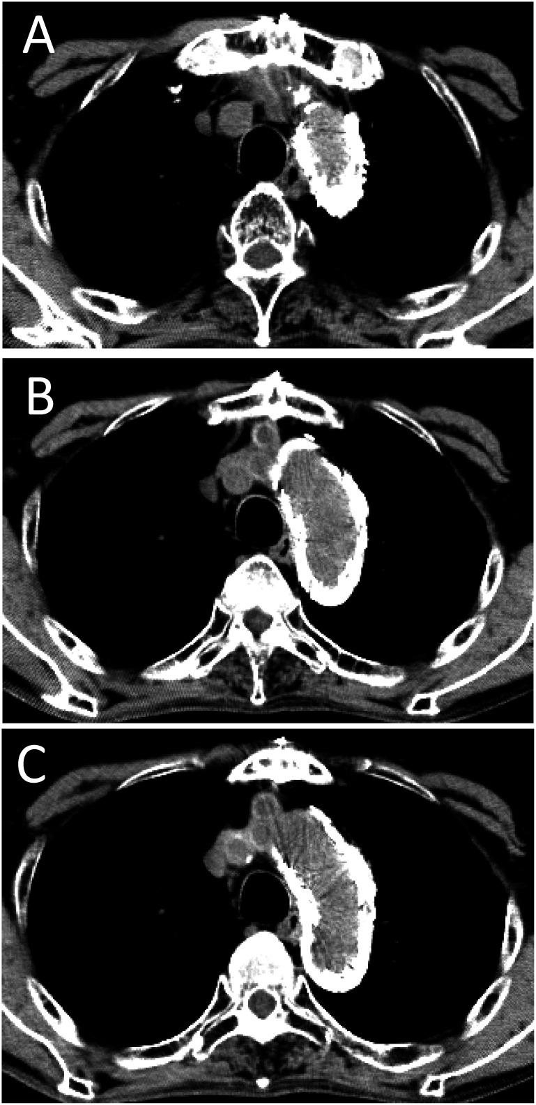 Fig. 3 Computed tomography after all treatments (1-year follow-up).