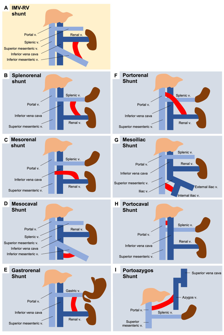 Acquired Portosystemic Shunts in Cirrhosis and Portal Vein Thrombosis ...