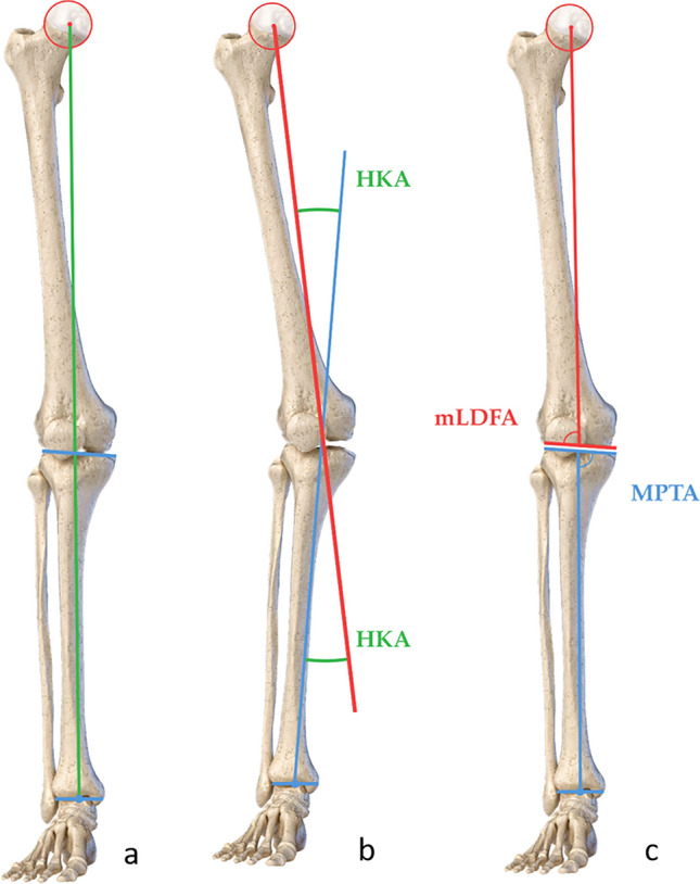 Distal femoral osteotomy for the valgus knee: indications ...