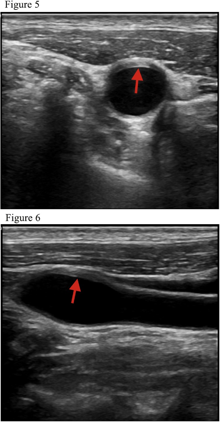 Figure B-1 (axial) and B-2 (longitudinal)