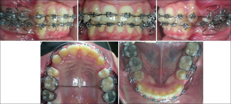 En masse retraction versus two-step retraction of anterior teeth in ...