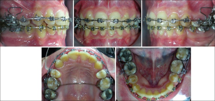 En masse retraction versus two-step retraction of anterior teeth in ...