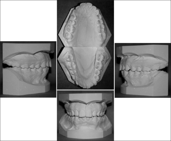 En masse retraction versus two-step retraction of anterior teeth in ...