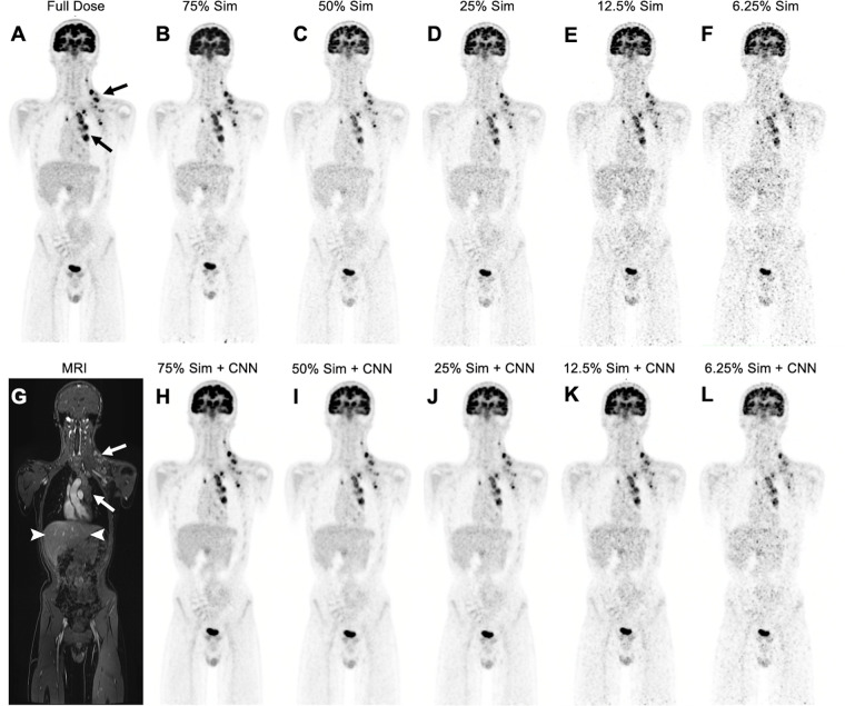 Low-dose and deep learning–enhanced PET images in a 14-year-old boy with Hodgkin lymphoma. (A) Full-dose fluorine 18 (18F) fluorodeoxyglucose (FDG) PET image (3 MBq/kg) shows hypermetabolic mediastinal and left infra- and supraclavicular lymph nodes (arrows). (B–F) Simulated 75% (75% Sim) (B), 50% (50% Sim) (C), 25% (25% Sim) (D), 12.5% (25% Sim) (E), and 6.25% (6.25% Sim) (F) dose 18F-FDG PET images and (G) corresponding MRI scan obtained with liver acquisition with volume acceleration sequence show increased noise and reduced contrast between tumor (arrows) and liver (arrowheads in G) with simulated reduced radiotracer dose. (H–L) Convolutional neural network (CNN)–augmented low-dose 18F-FDG PET images at 75% (H), 50% (I), 25% (J), 12.5% (K), and 6.25% (L) dose show reduced noise and improved contrast between tumor and liver compared with non-CNN–augmented PET images.