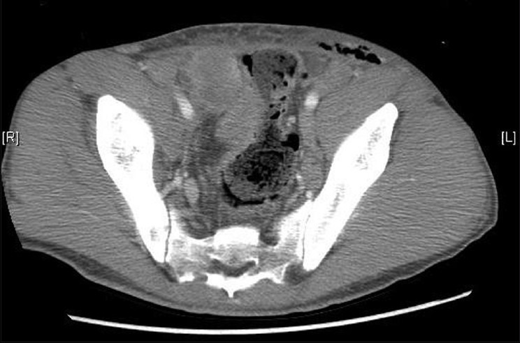 Inguinal Lymph Node Metastasis Of Colon Cancer Pmc 7376