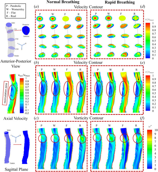 Normalized velocity and vorticity contours subjected to parabolic, Womersley, flat and real inlets are shown along the cross-sectional and sagittal planes for different breathing rates: (a)–(c) normal and (d)–(f) rapid, respectively. The anterior-posterior view and the sagittal plane are revealed as slices cut along these planes for reference. The normalized axial velocity plot indicates regions of negative velocity in the recirculation zone. Arrows indicate the flow direction.
