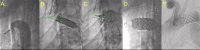 Aortic coarctation angioplasty.