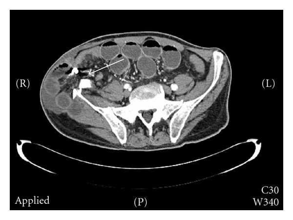 Small Bowel Obstruction Caused by an Incarcerated Hernia after Iliac ...