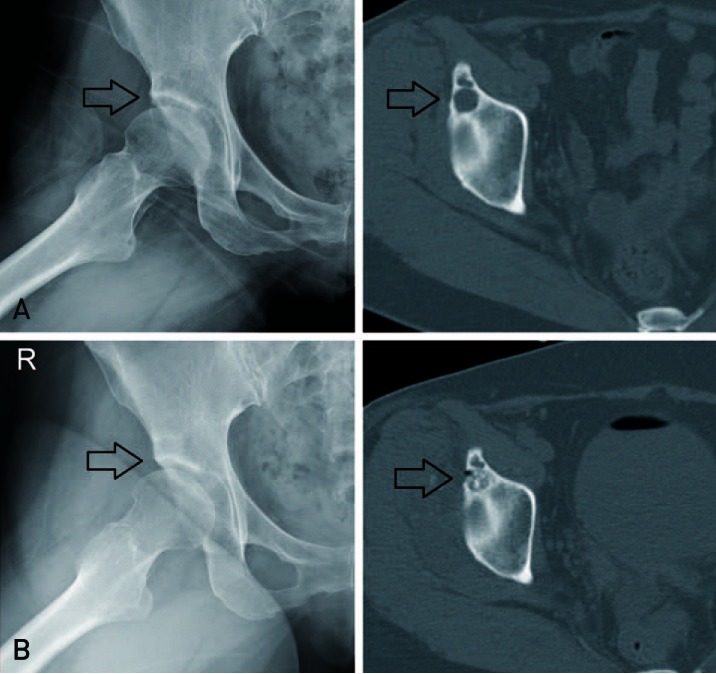 Arthroscopic Treatment of Subchondral Bony Cyst in Early Osteoarthritis ...