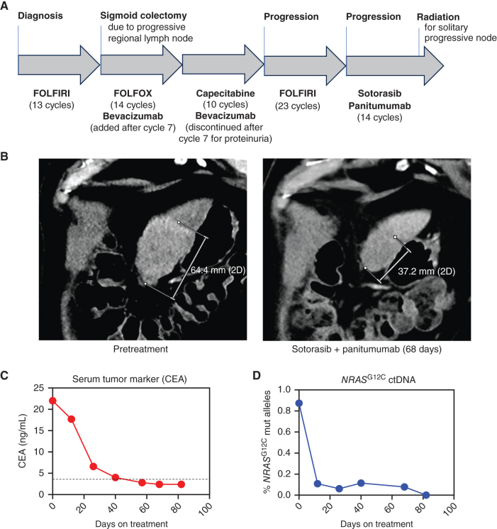 Figure 4. Clinical response in a patient with NRASG12C colorectal cancer treated with sotorasib and panitumumab. A, Graphical representation of the patient's treatment history. B, CT scans taken pretreatment and after 68 days of combined therapy with sotorasib and panitumumab with measurements of the dominant metastatic liver lesion shown. C, Serial serum CEA tumor marker measurements were obtained before and throughout treatment. The dotted horizontal line represents the upper limit of normal (3.5 ng/mL). D, The mutant allele fraction of NRASG12C was assessed in serial ctDNA speciments collected before and throughout therapy by ddPCR.