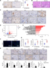 Figure 8. Conditional Mlycd-knockout mice confirmed the function of endogenous Mlycd. A and B, Representative imaging of IHC of Mlycd and hematoxylin and eosin (H&E) staining in kidney tissues from the kidney proximal tubules–specific Mlycd-knockout mice (Mlycd-CKO) and the control mice (WT). Statistical analysis based on immunoreactivity score (IRS). C, Representative imaging of IHC of RCC biomarkers (Ki67, vimentin, Ca-ix, Rcc, Ck-7) in kidney tissues from Mlycd-CKO and WT mice. D, Volcano plot demonstrating DEGs in kidney tissues from Mlycd-CKO versus WT mice. E, Bar graph showing that the Top 15 GSEA and GO of hallmark gene sets based on the P value. F, Representative imaging of LDs staining with Bodipy in kidney tissues from Mlycd-CKO and WT mice. G, Levels of malonyl-CoA, FFA and TG in kidney tissues from Mlycd-CKO and WT mice. H, Representative imaging of IHC of Plin2, Perk, Ptgs2, Scd, caspase-3, and Tunel in kidney tissues from the kidney proximal tubules–specific Mlycd-knockout mice (Mlycd-CKO) and the control mice (WT). Statistical analysis based on immunoreactivity score (IRS) or percentage of positive cells. Student t test; ns, not significant; **, P < 0.01; ***, P < 0.001.