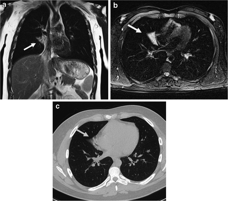 Practical protocol for lung magnetic resonance imaging and common ...