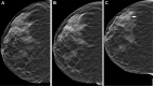 Example images from three successive rounds of digital breast tomosynthesis. Right craniocaudal tomosynthesis section in a 66-year-old woman screened in (A) 2020, (B) 2021, and (C) 2022 with a new area of architectural distortion identified in 2022 (arrow), which led to a cancer diagnosis.