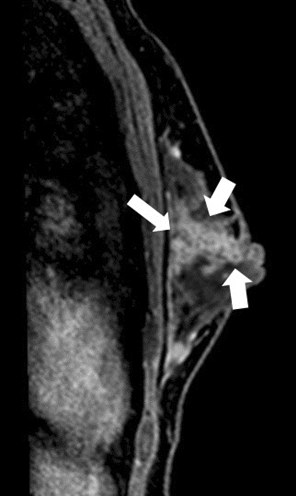 Magnetic resonance imaging diagnosis of non mass enhancement of the