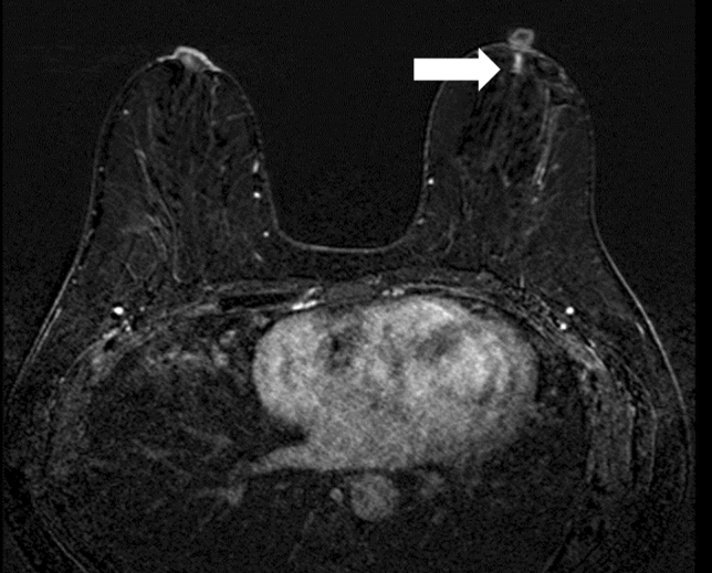 Magnetic resonance imaging diagnosis of non mass enhancement of the