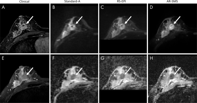 Large lesion example. Shown are, A, contrast-enhanced image, E, T2-weighted image, B–D, images with b value of 800 sec/mm2, and, F–H, apparent diffusion coefficient (ADC) maps, which are focused on an example of a large contrast-enhanced lesion (arrow). Radiologists were asked to measure the longest dimension on (B–D) images with b value of 800 sec/mm2 and (F–H) a lesion-average ADC by drawing a freehand two-dimensional region of interest on each ADC map. The longest lesion diameter was 28.8 mm, measured on the contrast-enhanced subtraction image and averaged across all readers. Average measurements on images with b value of 800 sec/mm2 were as follows: B, standard, 26 mm; C, readout-segmented (RS) echo-planar imaging, 25.6 mm; and D, axially reformatted (AR)–simultaneous multislice (SMS) image, 26 mm. Average ADC measurements were as follows: F, standard, 0.88 ×10−3 mm2/sec; G, RS echo-planar imaging, 0.93 ×10−3 mm2/sec; and, H, AR-SMS imaging, 0.84 ×10−3 mm2/sec. The average quality scores on a five-point Likert scale were as follows: standard, 2.3; RS echo-planar imaging, 3.0; and AR-SMS imaging, 4.0.