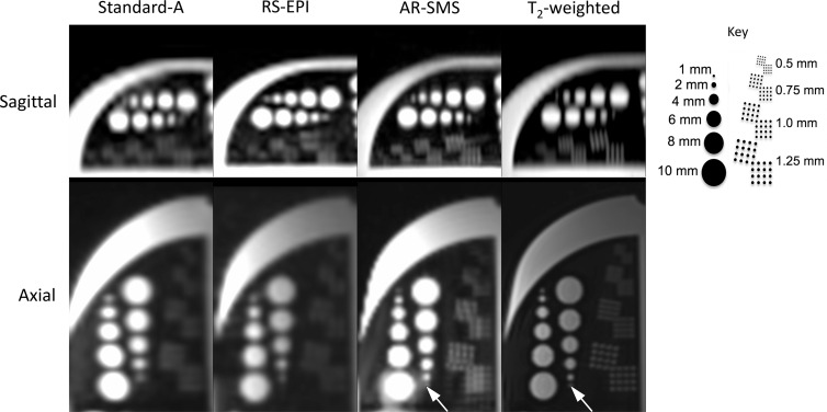 Resolution phantom comparing feature detection on b = 0 sec/mm2 images. Key indicates feature sizes. The smallest feature (1 mm), indicated by an arrow, was only considered visible on the axially reformatted–simultaneous multislice (AR-SMS)and T2-weighted axial images. The 1 mm and 1.25 mm dots in the resolution grids are differentiable on axially reformatted simultaneous multislice and T2-weighted images. RS-EPI = readout-segmented echo-planar imaging.