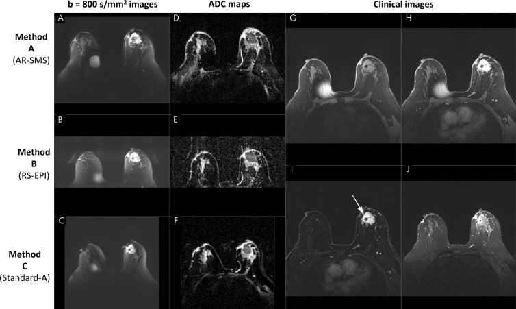 Screenshot of a picture archiving and communication system setup in a 70-year-old participant with large biopsy-proven cancer. Readers were provided with clinical images, including, G, a noncontrast-enhanced image, H, a single contrast-enhanced image, I, a contrast-enhanced subtraction T1-weighted image, and, J, a T2-weighted image, with the lesion indicated (arrow). Diffusion data included axial images with, A–C, b value of 800 sec/mm2 and, D–F, apparent diffusion coefficient (ADC) maps for all three methods, randomly ordered as methods A, B, and C, which are labeled here for illustration purposes. The metal needle of the contrast injection port caused the artifact on the right breast. AR-SMS = axially reformatted–simultaneous multislice, RS-EPI = readout-segmented echo-planar imaging.