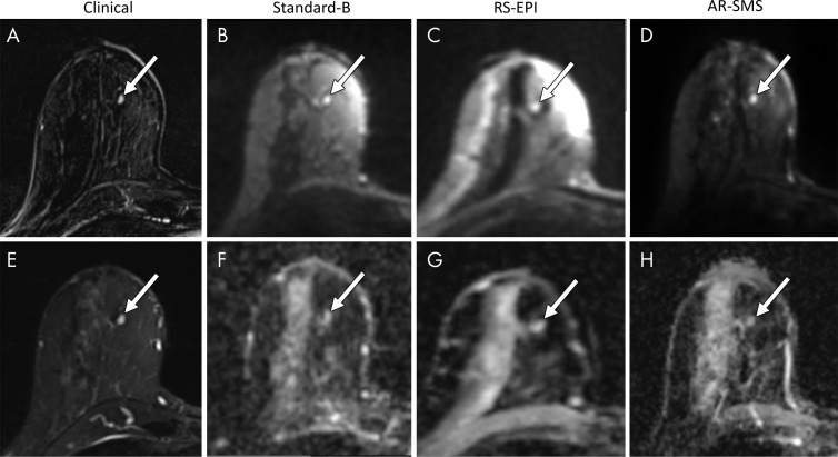 Small lesion example. Shown are, A, a contrast-enhanced subtraction image, E, a T2-weighted image, B–D, images with b value of 800 sec/mm2, and, F–H, apparent diffusion coefficient (ADC) maps, focused on an example of a small contrast-enhanced lesion (arrow). Radiologists were asked to measure the longest dimension on images with b value of 800 sec/mm2 (B–D) and a lesion-average ADC by drawing a freehand two-dimensional region of interest on each ADC map (F–H). The longest lesion diameter was 4.7 mm, measured on the contrast-enhanced subtraction image (A) and averaged across all readers. Average measurements on images with b value of 800 sec/mm2 were as follows: B, standard, 5.8 mm; C, readout-segmented (RS) echo-planar imaging (EPI), 4.6 mm; and D, axially reformatted (AR)–simultaneous multislice (SMS) image, 5.5 mm. Average ADC measurements were as follows: F, standard, 1.45 × 10−3 mm2/sec; G, RS echo-planar image, 1.59 ×10−3 mm2/sec; and H, R-SMS image, 1.34 ×10−3 mm2/sec. The average quality scores on a five-point LIkert scale were as follows: standard, 2.3; RS echo-planar imaging, 2.7; and AR-SMS imaging, 3.7.