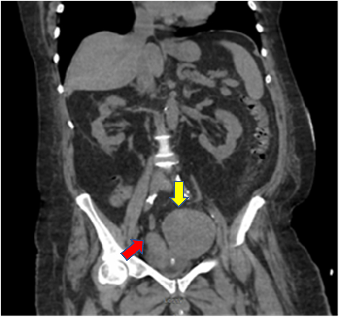 Muscle invasive angiosarcoma of the urinary bladder case report pmc