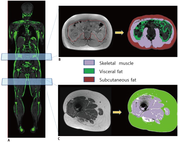 Recent Issues on Body Composition Imaging for Sarcopenia Evaluation - PMC