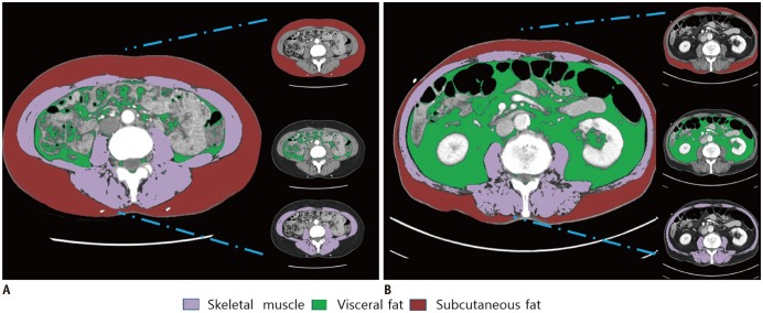 Recent Issues on Body Composition Imaging for Sarcopenia Evaluation - PMC