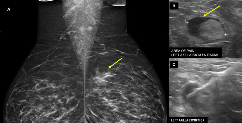 38-year-old presented for evaluation of left breast and left axillary pain. A, Bilateral MLO views demonstrate an asymmetry (yellow arrow) in the left superior breast which was biopsied as pseudoangiomatous stromal hyperplasia. B, Ultrasound evaluation of the left axilla demonstrates a lymph node with abnormally thickened cortex (yellow arrow). C, Ultrasound guided core needle biopsy for lymph node revealed reactive follicular hyperplasia.