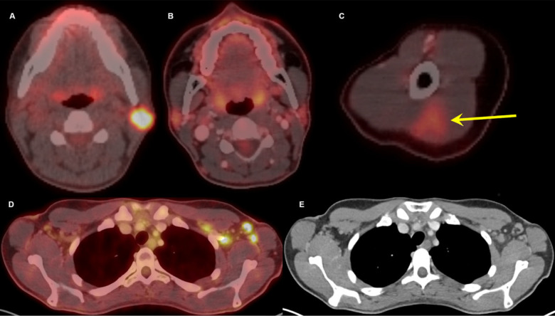 Thirty-two-year-old female. A, Axial fused 18-FDG PET/CT showed hypermetabolic biopsy proven intraparotid lymph node with metastatic malignant melanoma. B, Three-month follow-up axial fused 18-FDG PET/CT shows complete resolution of the neck mass following chemotherapy, C, while left arm shows hypermetabolic triangular shaped inflammation (arrow) at the COVID vaccine injection site. D, Axial fused images at the axilla level shows multiple new hypermetabolic lymph nodes. E, Axial contrast enhanced CT demonstrates mild fat stranding surrounding the ovoid lymph nodes with preserved fatty hilum.