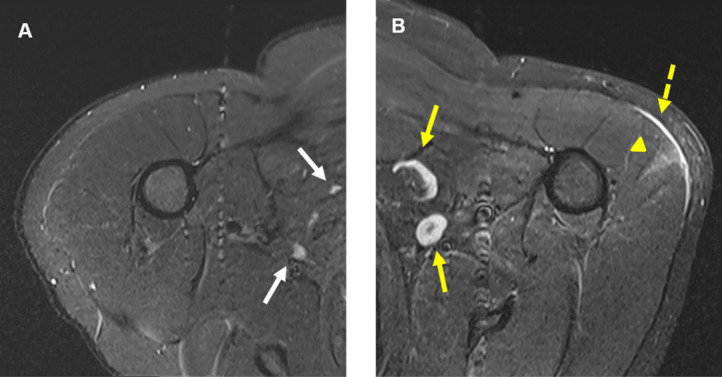 41-year-old male. A, Axial T2-STIR MRI of the right shoulder shows normal looking muscular and osseous structures, and normal lymph nodes (white arrows). B, Axial T2-STIR MRI of the left shoulder correspondent to the level of A, shows new subcutaneous edema (dashed yellow arrow) overlying a wedge-shaped intramuscular edema (yellow arrowhead) in the left deltoid muscle. In addition, there are multiple prominent ovoid shaped lymph nodes (yellow arrows) in the ipsilateral axilla, asymmetric to the right and new compared with prior MRIs (not shown).