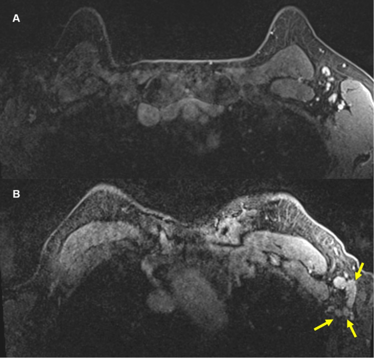 57-year-old female. A, Axial contrast enhanced fat saturated T1 sequence of MRI from a year ago showed sub-centimeter, benign lymph nodes in the left axilla. B, Most recent contrast enhanced axial fat saturated T1 sequence at approximately same level showed multiple new, enlarged lymph nodes (yellow arrows) in the left axilla. There were no other suspicious findings to suggest a breast cancer primary.