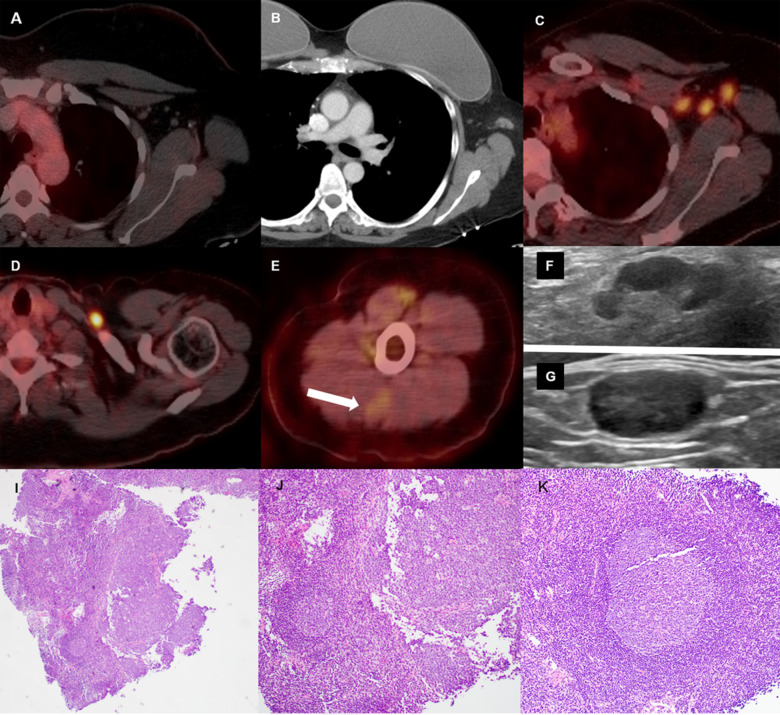 46-year-old female with triple negative left breast cancer, disease free for three years. A, Axial fused 18-FDG PET/CT three years earlier with no concerning lymph node in the left axilla. B, Surveillance contrast enhanced axial chest CT showed new left axillary lymphadenopathy with fat stranding 15 days after the first Covid-19 vaccine. Further evaluation with PET/CT six days after the 2nd dose of vaccine, demonstrated, C, multiple enlarged hypermetabolic left axillary lymph nodes and, D, a hypermetabolic round shaped left supraclavicular lymph node in axial fused 18-FDG PET/CT images. E, A subtle wedge-shaped intramuscular hypermetabolism (white arrow) was also noted in this case, similar to first and third cases. Ultrasonography guided core needle biopsy was performed. F, On ultrasonography, axillary lymph nodes had thickened cortex while the supraclavicular lymph node demonstrated, G, thickened cortex with loss of normal fatty hilum. I, Hematoxylin and eosin staining under 40x magnification shows enlarged germinal center with interfollicular expansion by small lymphocytes. 100x magnification images show, J, prominent germinal center with tingible body macrophage and, K, reactive germinal center with expansion of interfollicular regions by small lymphocytes and focally prominent endothelial cells.