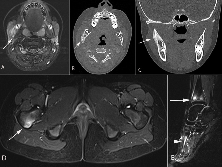 Chronic recurrent multifocal osteomyelitis. A narrative and pictorial ...