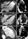 Example contrast-enhanced cardiac MRI (CMR) and conventional
transthoracic echocardiography for detecting left ventricular (LV) thrombi
in patients diagnosed with embolic stroke of undetermined source. (A, B)
Images in an 85-year-old male patient show a large apical thrombus (arrows)
on both the CMR scan (A) and the transthoracic echocardiogram (B). (C, D)
Images in an 82-year-old male patient show a small apical thrombus on the
CMR scan (arrow in C) but not on the transthoracic echocardiogram (D)
because the apical view image was diminished by an artifact. (E, F) Images
in a 74-year-old male patient show a mural thrombus of the posterior wall on
the CMR scan (arrows in E) but not on the transthoracic echocardiogram (F).
Ao = ascending aorta, LA = left atrium. (Reprinted, with permission, from
reference 56.)