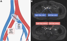 (A) Illustration of May-Thurner syndrome, which is clinically associated
with cryptogenic stroke, shows the left iliac vein compressed by the right iliac
artery. (B) Two-dimensional time-of-flight MR angiographic images in a
30-year-old female patient diagnosed with cryptogenic stroke show narrowing of
the left iliac vein caused by the overlying right iliac artery, consistent with
May-Thurner syndrome.