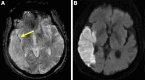 Brain MRI in a 71-year-old male patient diagnosed with cryptogenic
stroke. (A) T2*-weighted image shows the susceptibility vessel sign
(arrow) in the M2 segment of the right middle cerebral artery. (B)
Diffusion-weighted image shows the corresponding ischemic area.