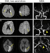 Example diffusion-weighted imaging (DWI) and MR angiography (MRA) in
patients with stroke. (A) Images in a 54-year-old male patient diagnosed with
cryptogenic stroke show multiple bilateral cortical-subcortical and
periventricular infarcts on the DWI scan (arrows, left), while MRA (right) and
transesophageal echocardiography were unrevealing. (B) Images in a 44-year-old
male patient with stroke attributed to large artery atherosclerosis show
multiple unilateral small subcortical infarcts on the DWI scan (arrows, left)
and severe focal stenosis of the ipsilateral middle cerebral artery on the MR
angiogram (arrowhead, right). (C) Images in an 82-year-old male patient with
stroke attributed to a cardioembolic source show large territorial infarcts on
the DWI scan (arrows, left) and occlusion of the left posterior cerebral artery
on the MR angiogram (arrowhead, right).