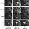 MR images of carotid plaque show the complicated characteristics of
American Heart Association (AHA) type VI plaques. The presence of at least one
of the following criteria defines plaques as type VI: intraplaque hemorrhage
(red arrowheads, left), ruptured fibrous cap (yellow arrowheads, middle), or
mural thrombus indicating juxtaluminal hemorrhage (white arrowheads, right). CE
= contrast-enhanced, TOF = time of flight, T1WI = T1-weighted imaging, T2WI =
T2-weighted imaging. (Adapted, with permission, from reference 48.)