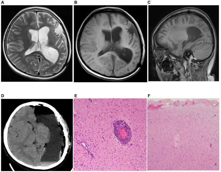 Misdirection Due To Early Magnetoencephalographic Presentation And 