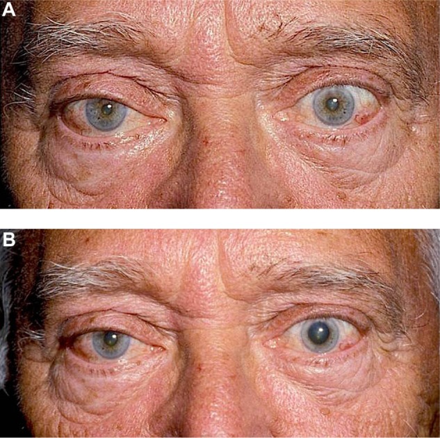 Horner syndrome: clinical perspectives - PMC