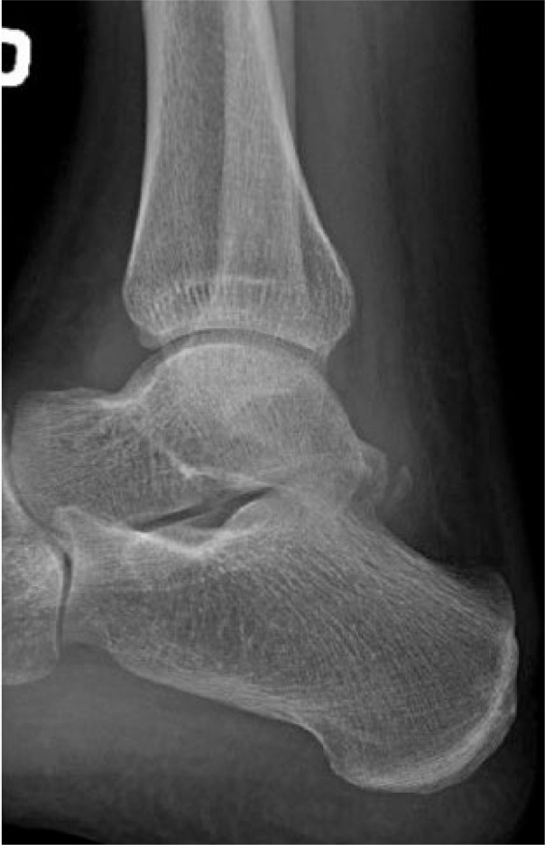 Fracture of the lateral tubercle of the posterior talar process caused ...