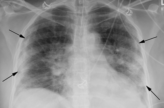 Characteristic chest radiograph in a 63-year-old woman presenting with dyspnea and fever. Chest radiographic findings include bilateral patchy and confluent, bandlike ground-glass and consolidative opacity in a peripheral, mid to lower lung zone distribution (arrows).