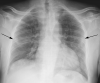 A more subtle characteristic radiograph in a 41-year-old man presenting with dyspnea and chest pain. Patchy ground-glass opacities are limited to the peripheral portions of the mid lung zones (arrows).