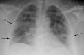 Characteristic chest radiograph in a 41-year-old woman presenting with cough and fever. Chest radiographic findings include bilateral patchy and confluent, bandlike ground-glass and consolidative opacity in a peripheral, mid to lower lung zone distribution (arrows).