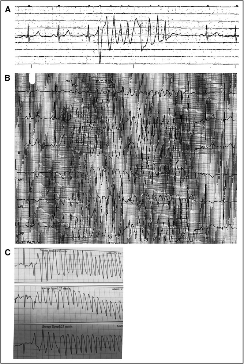 Figure 1. Ventricular tachycardia captured in patients on ibrutinib. (A) A brief run of nonsustained ventricular tachycardia is seen on telemetry shortly after a syncopal episode in a patient who had been taking ibrutinib 420 mg per day for 86 days. (B) A 20-beat run of polymorphic ventricular tachycardia experienced by the same patient with syncope while receiving ibrutinib. (C) Polymorphic ventricular tachycardia identified in a patient reporting presyncope after 28 days receiving ibrutinib 420 mg per day.