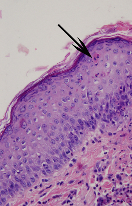 Prevalence of apoptotic epidermal keratinocytes in eosinophilic ...