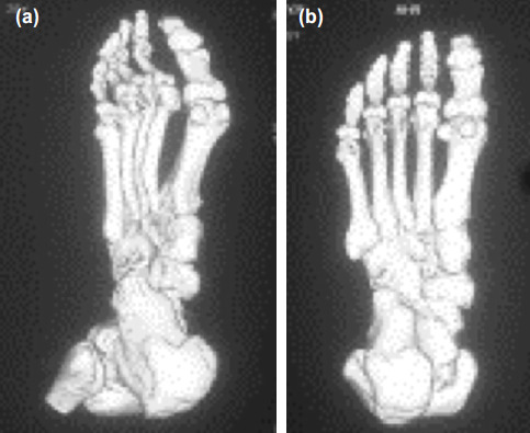 Surgical Management of Freiberg Disease by Dorsal Closing Wedge ...