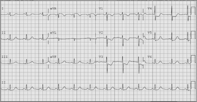 ECG Diagnosis: Isolated Posterior Wall Myocardial Infarction - PMC