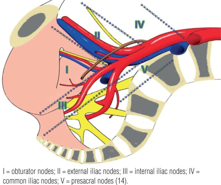 Pelvic lymph node dissection in high risk prostate cancer pmc