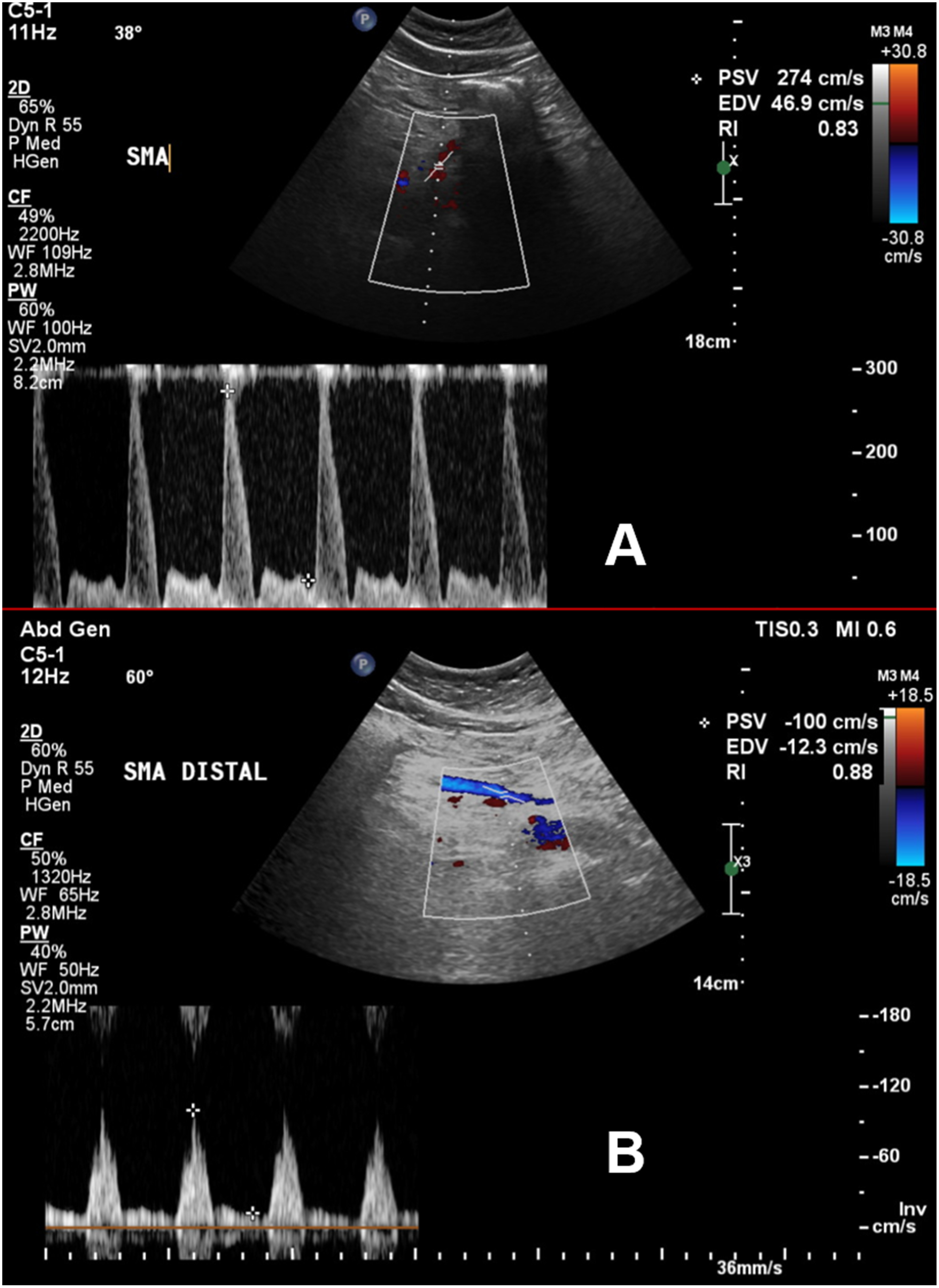 Fig. 4 (A) Duplex ultrasound 2 years post repair. There is increased velocity in the proximal superior mesenteric artery (SMA), indicating stent stenosis. (B) Duplex ultrasound 2 years post repair. The velocity is normal in the distal SMA, indicating patency and normal perfusion.