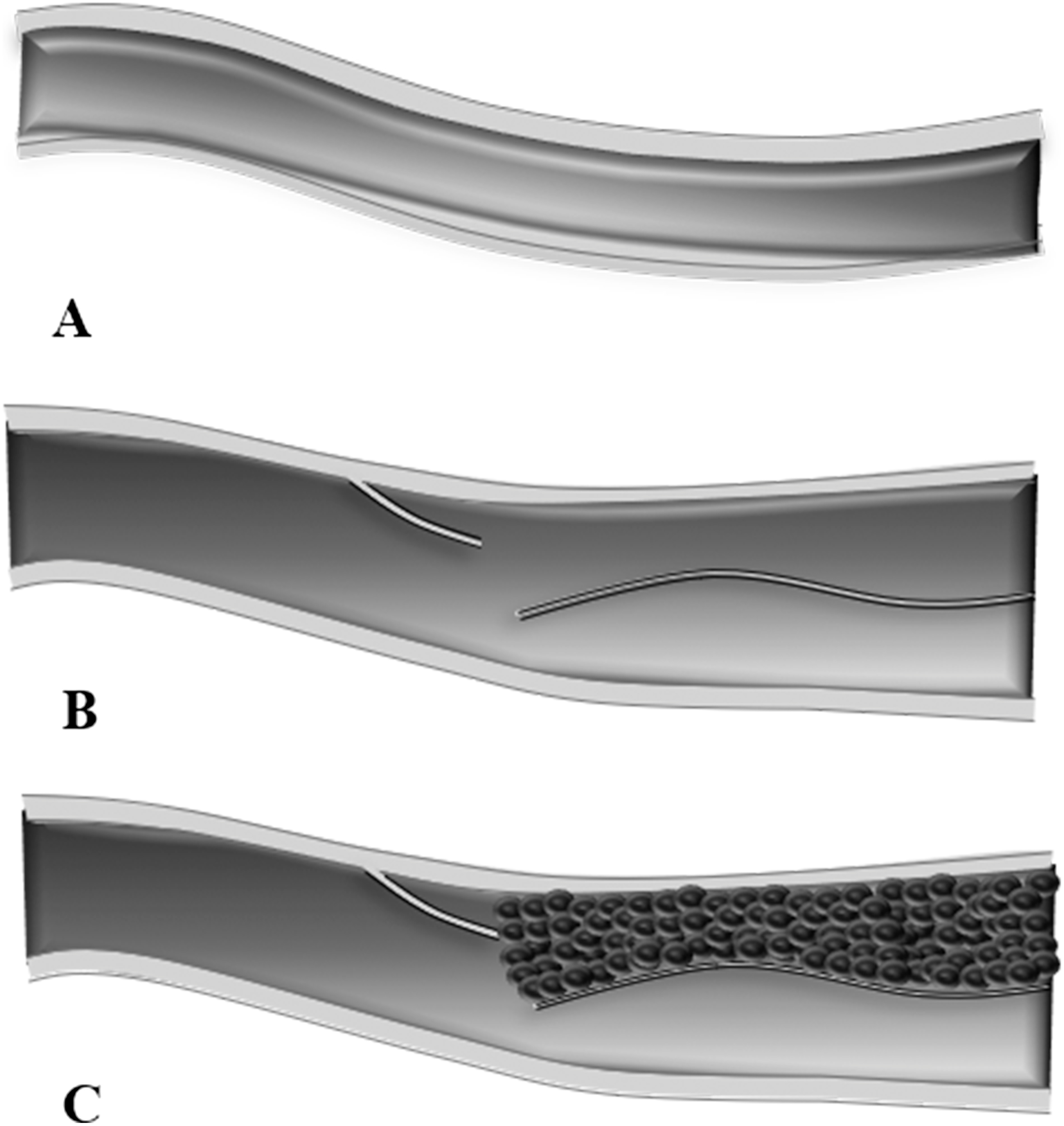 Fig. 1 (A) A patent artery. (B) Arterial dissection with patent true and false lumen. (C) Arterial dissection with patent true lumen and thrombosed false lumen.